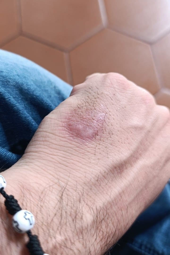 Photo of a wound on Mateo R.’s hand from a rubber pellet. 