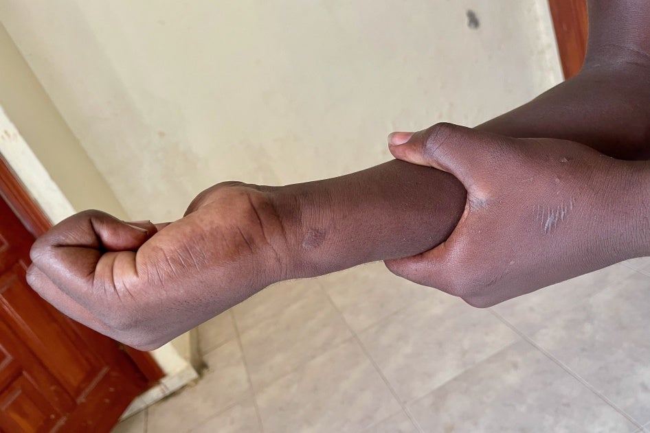 A 17-year-old Guinean boy shows scars on his wrists